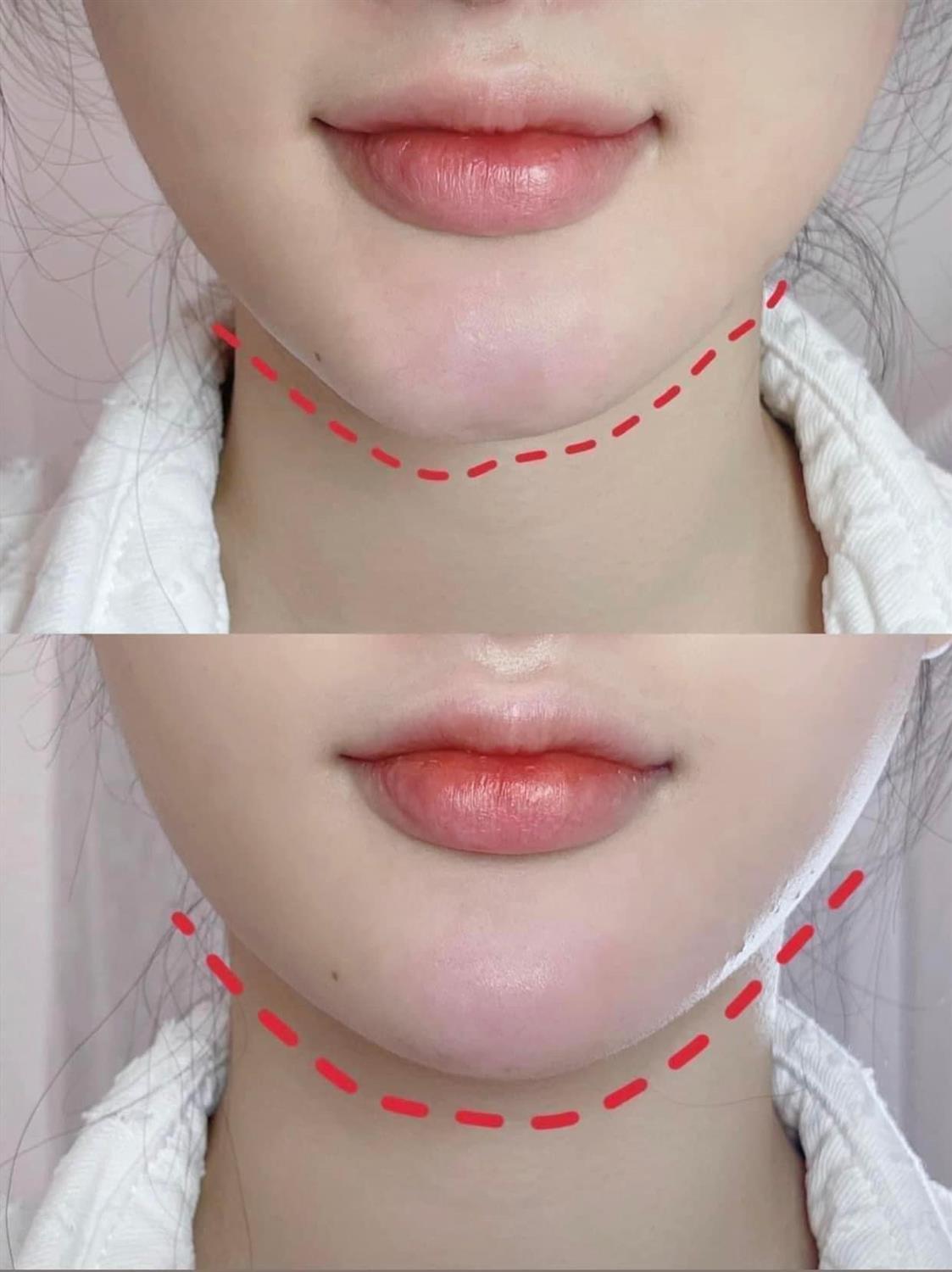 1. Tiêm Filler Cằm Tài Lộc Là Gì?